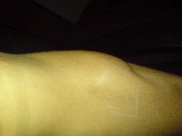 triceps
